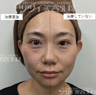 HIFUハイフの効果はいつから？痛み副作用・顔のリフトアップ効果の経過 