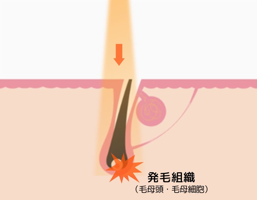 熱破壊式照射イメージ