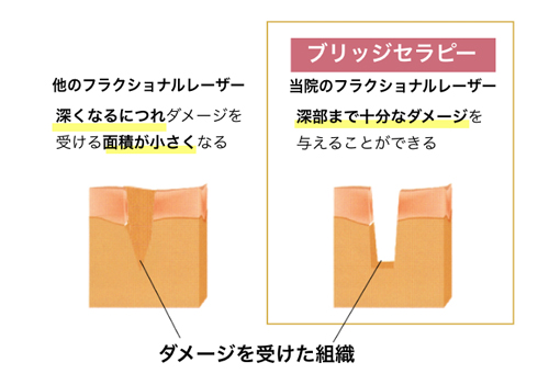 皮膚の深部までアプローチ、少ない治療回数で効果が期待できる