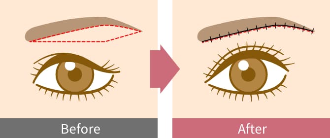 眉下リフト（眉下切開法）ビフォーアフター
