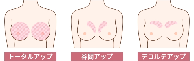 厚生労働省で認可されたヒアルロン酸製剤