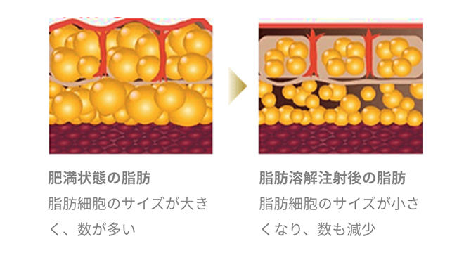 肥満状態の脂肪と脂肪溶解注射後の脂肪のイメージ図
