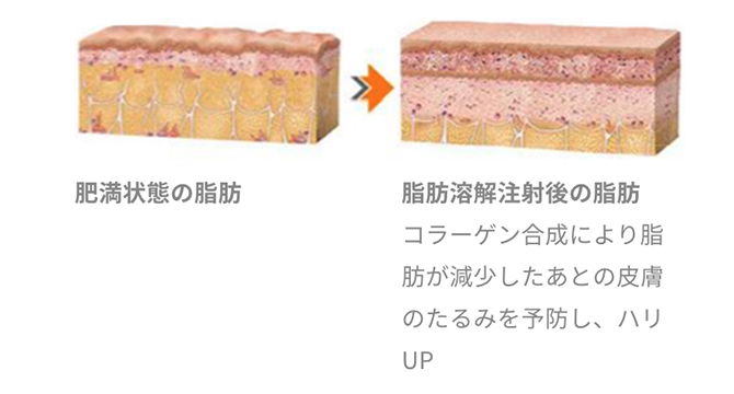 肥満状態の脂肪と脂肪溶解注射後の脂肪のイメージ図