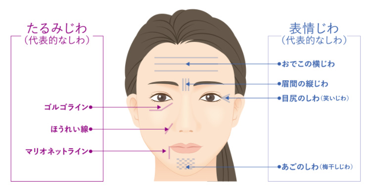 シワができる箇所とその特徴のイメージ画像