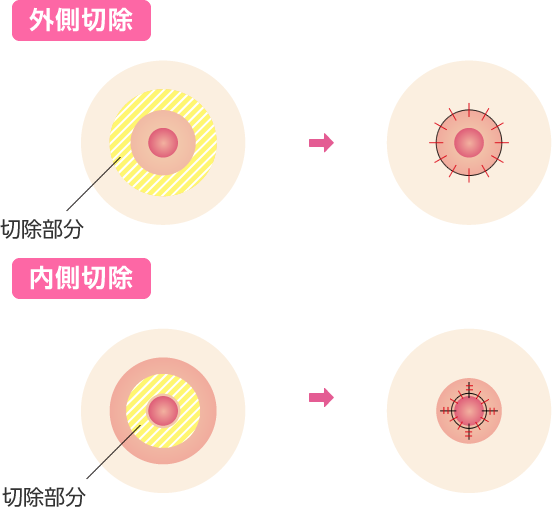 施術イメージ