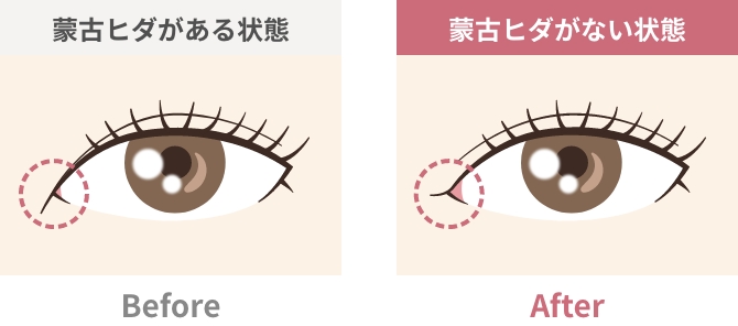 蒙古ヒダがある状態とない状態の比較