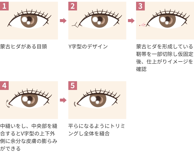 YV形成の流れ