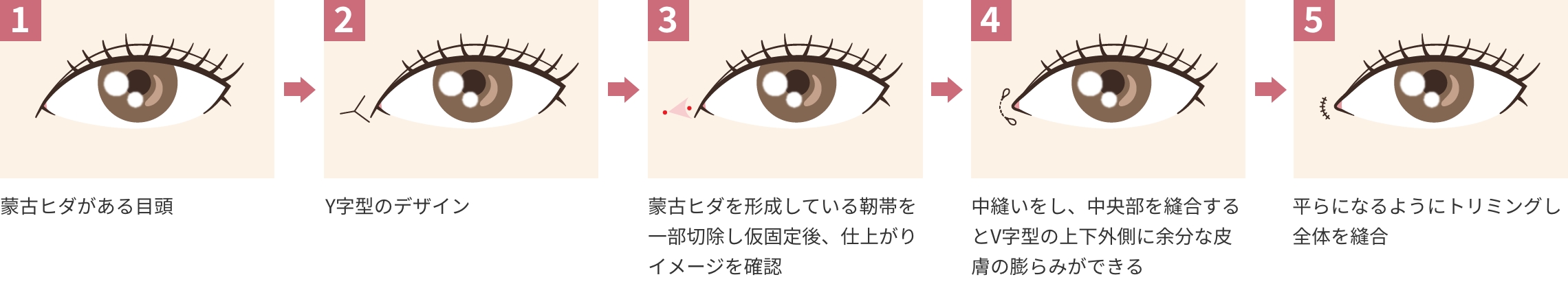 YV形成の流れ