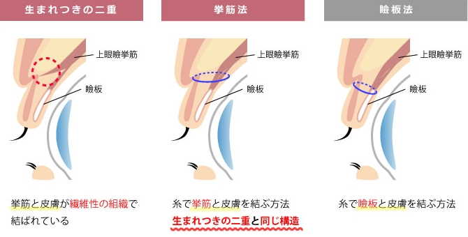 挙筋法と瞼板法の違いの図