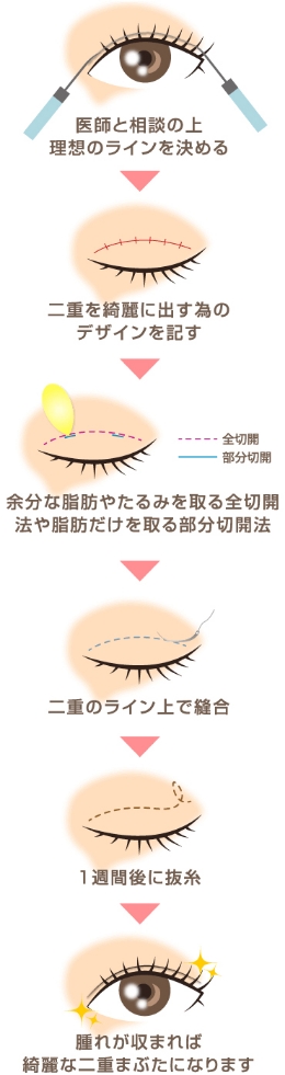 切開法の施術の流れ