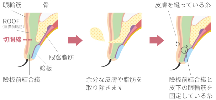 切開法の施術イメージ