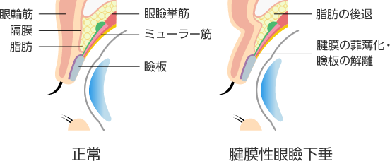 後天性眼瞼下垂イメージ