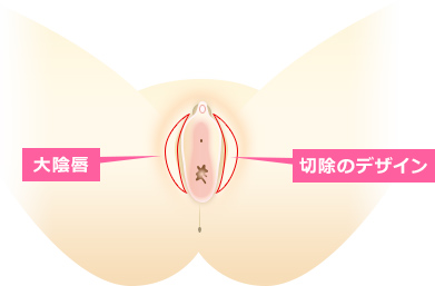 大陰唇縮小術・切除のデザイン