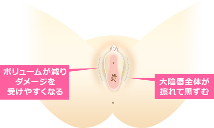 大陰唇脂肪注入とは