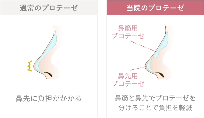 症状に合わせた切開施術