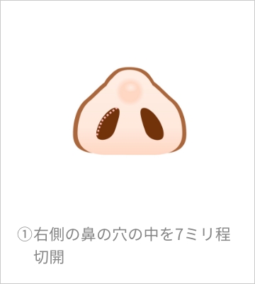 右側の鼻の穴の中を7ミリ程切開