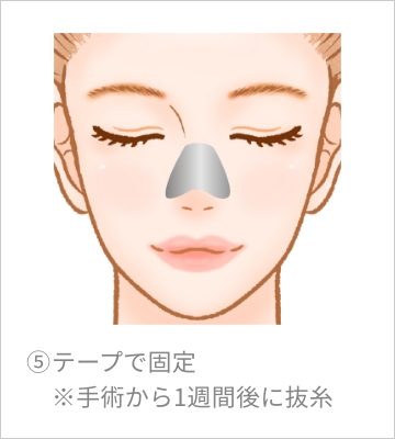 テープで固定※手術から1週間後に抜糸