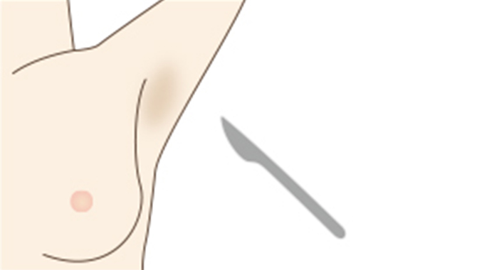 切開法のイメージ画像