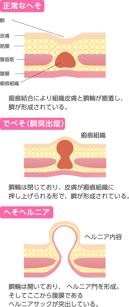 正常な臍（左）でべそ（中）、臍ヘルニア（右）