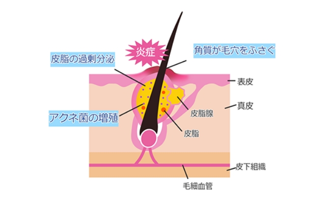 ニキビができるメカニズムとは？