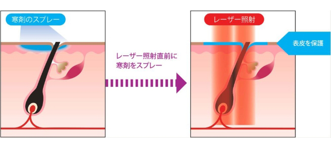 治療時のイメージ画像