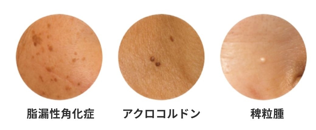 レーザーフェイシャルイメージ