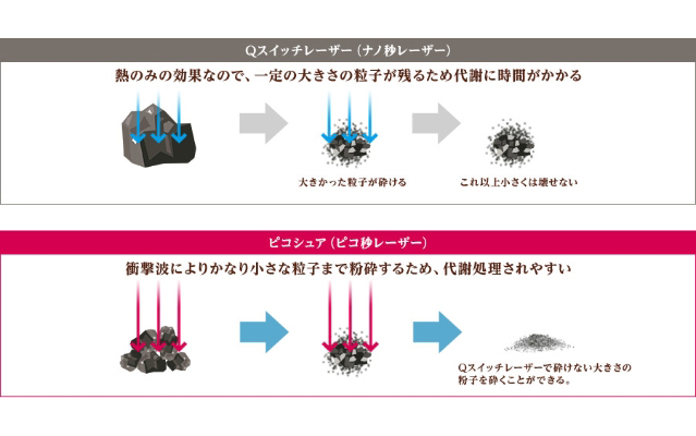 Qスイッチレーザーとピコシュアの比較