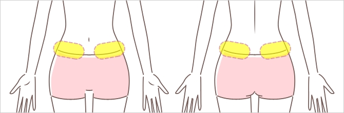 脇腹照射パターン