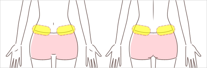 脇腹照射パターン