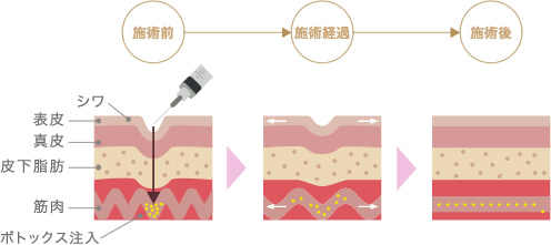 ボトックスの作用