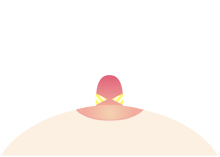 乳頭縮小