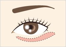 目の下の脂肪・たるみを取る