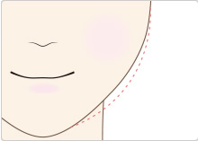 ほほ（脂肪）をほっそりする