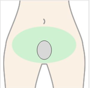 卵型