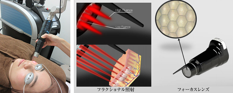 ピコレーザーピコシュア