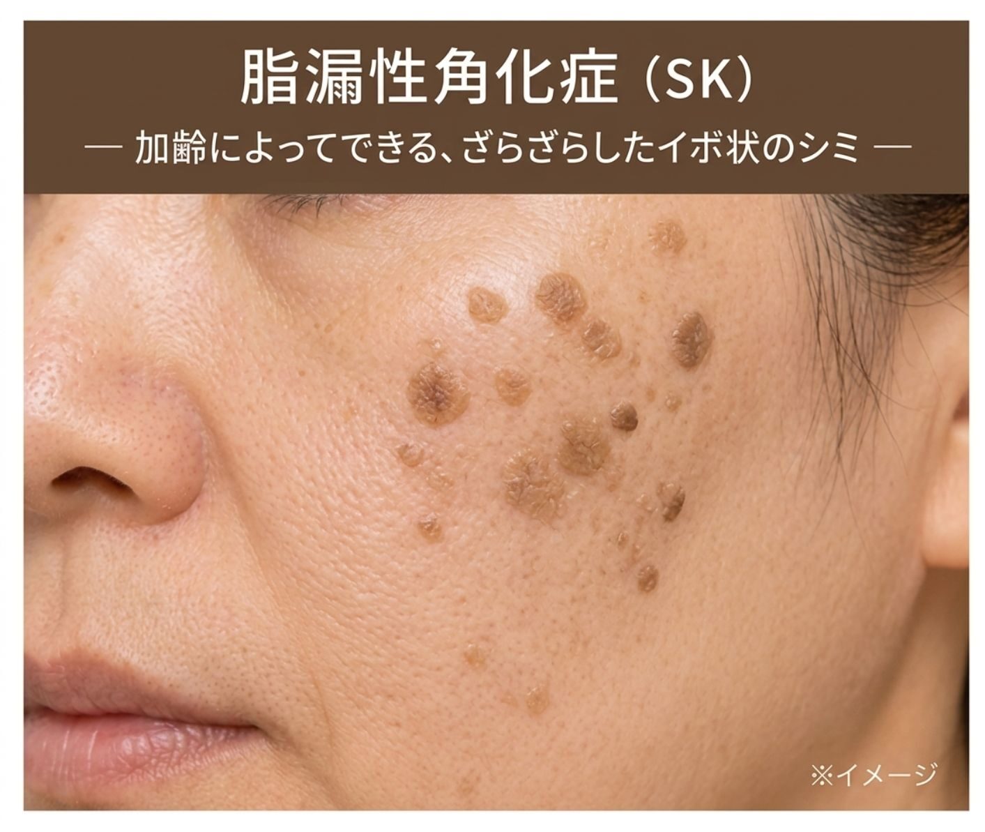 脂漏性角化症のイメージ画像