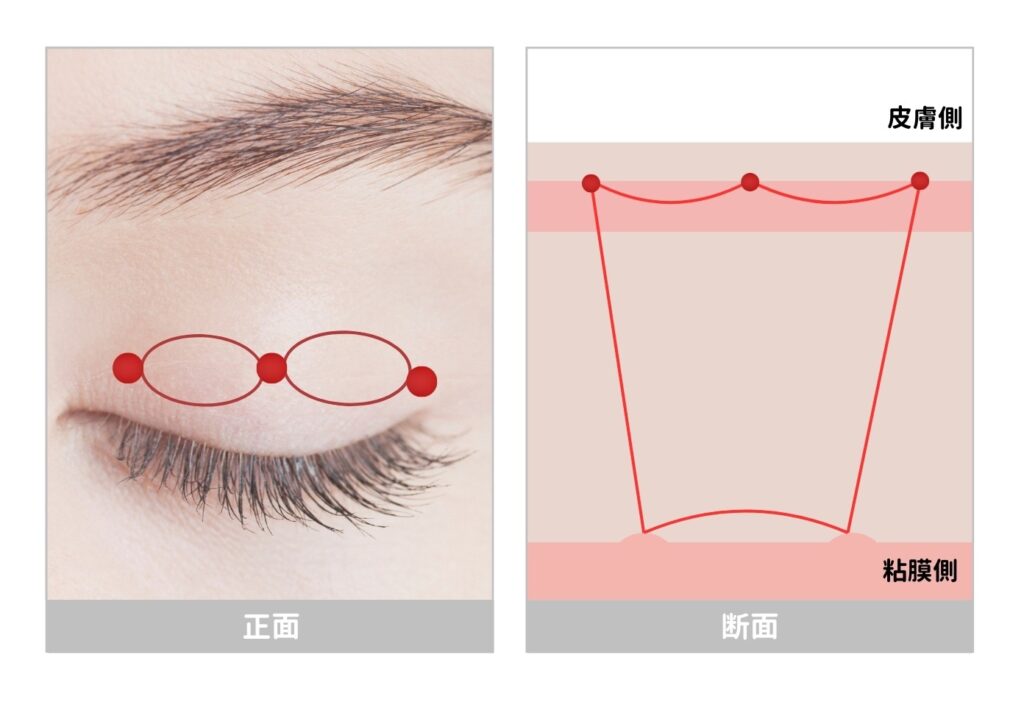 3点留め　埋没二重