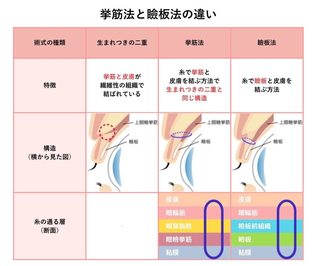 「挙筋法」と「瞼板法」の違い