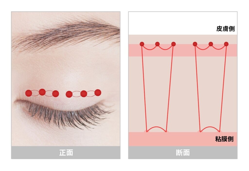 6点留め　埋没二重