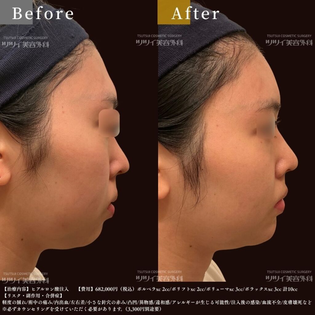 ヒアルロン酸 症例