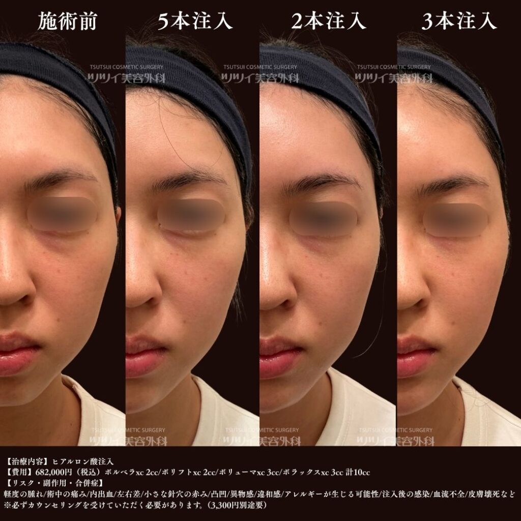 ヒアルロン酸注入　症例　まとめ2