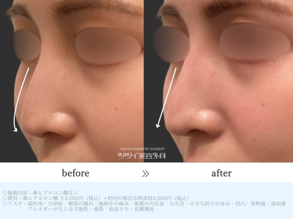 ヒアルロン酸　鼻症例