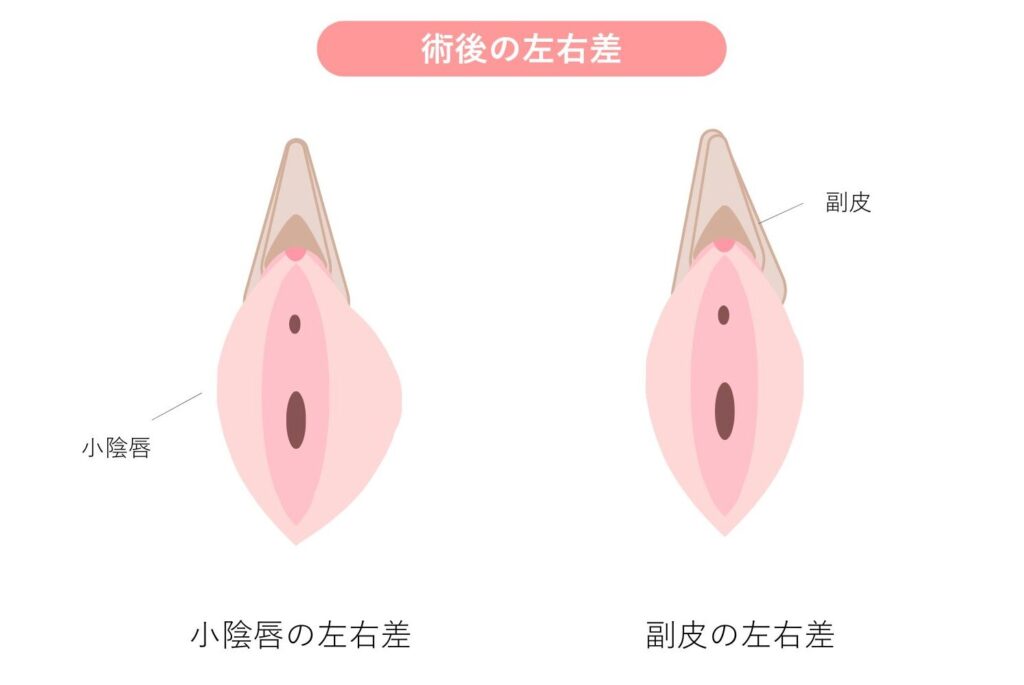 小陰唇縮小術　術前　術後　イメージ画像