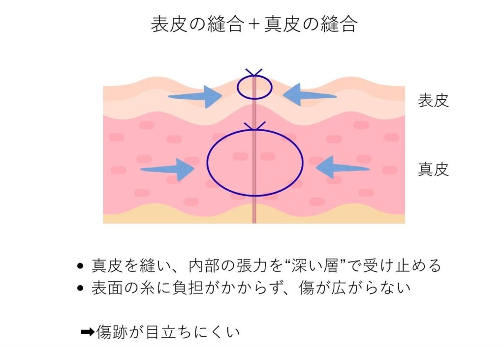 小陰唇縮小術　真皮縫合　図解説明