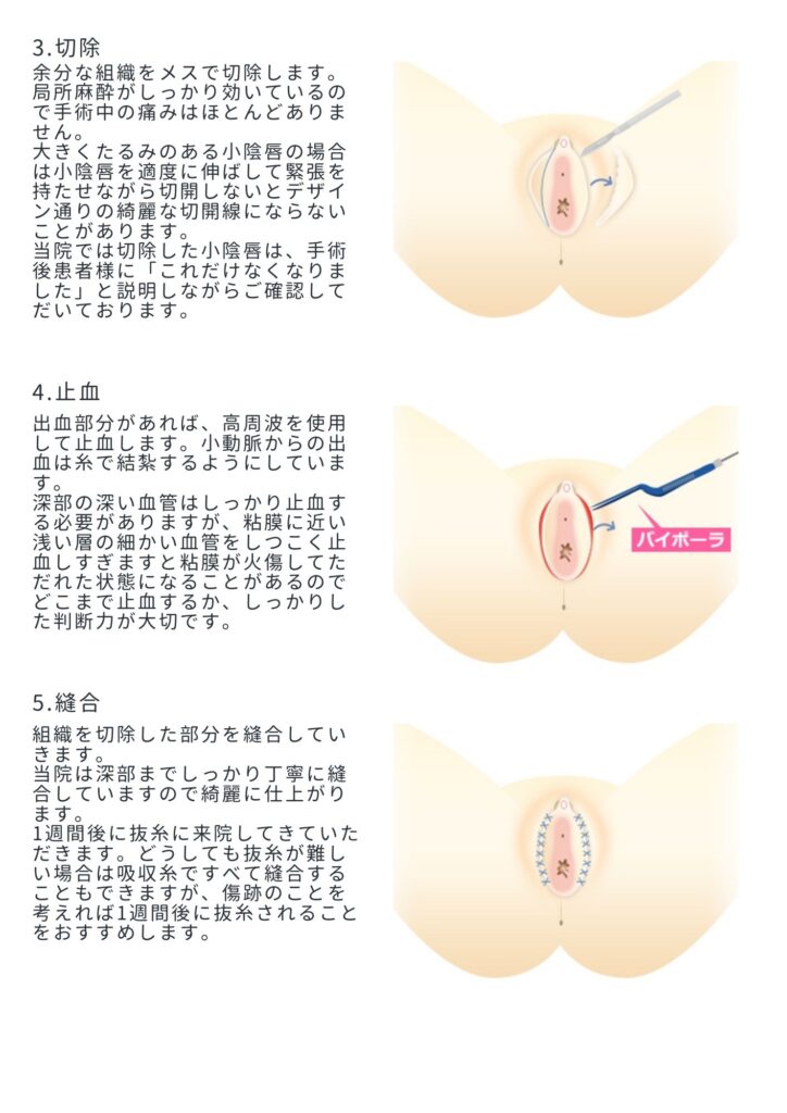 小陰唇縮小 術式