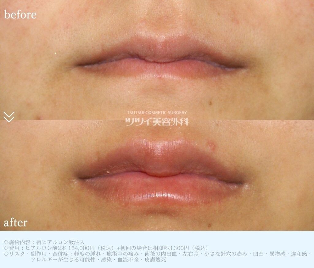 ヒアルロン酸　唇症例