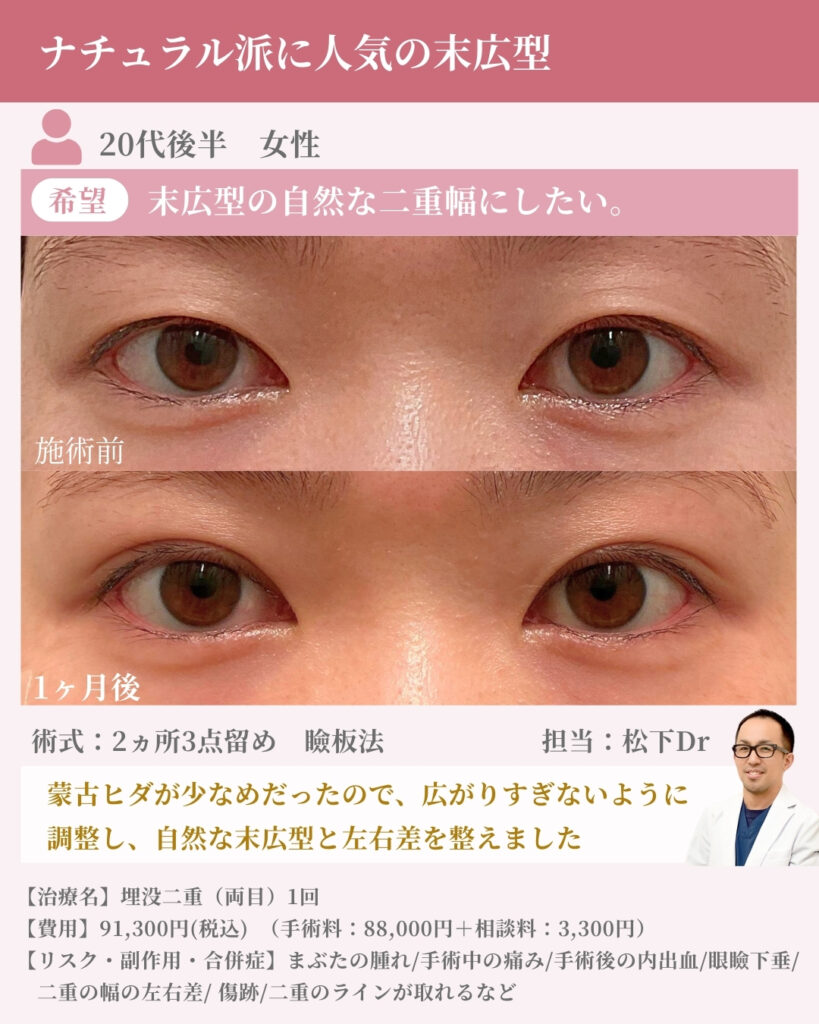 ナチュラル派に人気の末広型症例　埋没二重