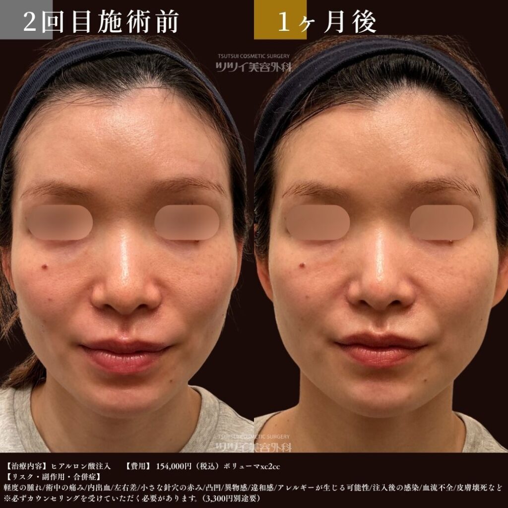 ヒアルロン酸 症例