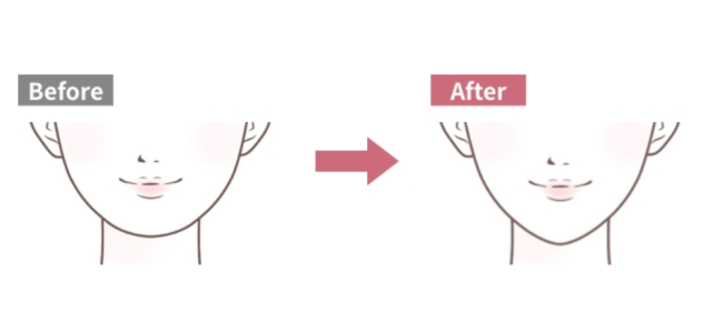 ヒアルロン酸注入(顎)