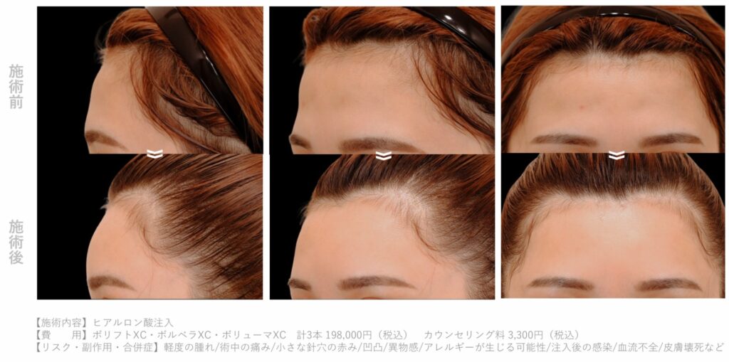 ヒアルロン酸　額症例